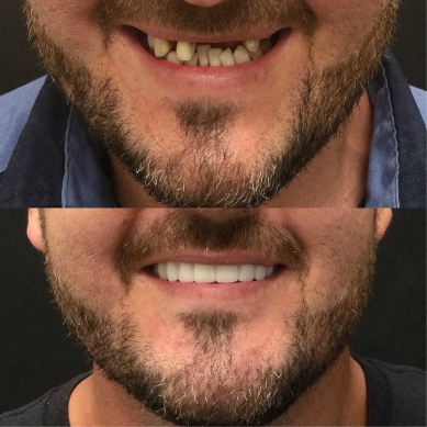 Before and after smile transformation showing improved teeth with dentures treatment.