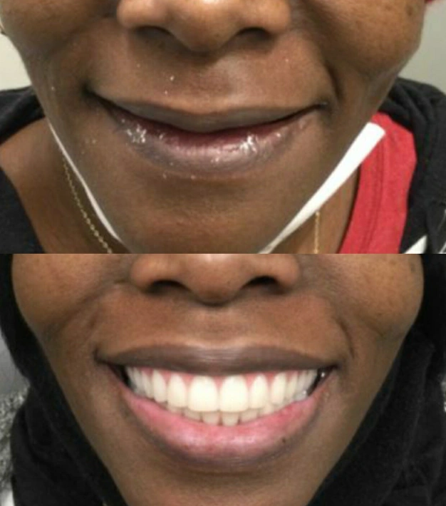 Dentures before and after