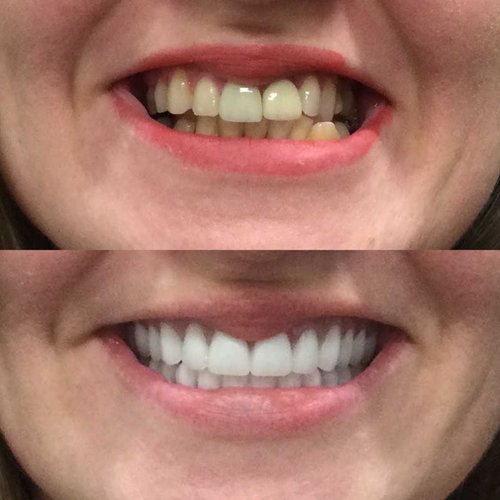 Before and after comparison of teeth whitening results showing yellowed teeth transformed to bright white smile.