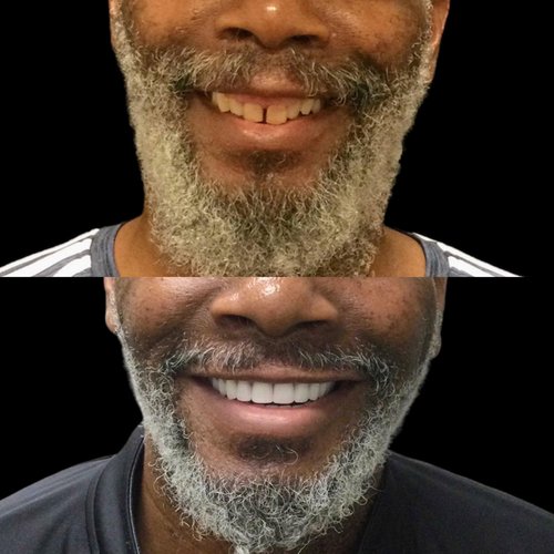 Before and after dentures comparison showing two men's smiles demonstrating dental transformation results.