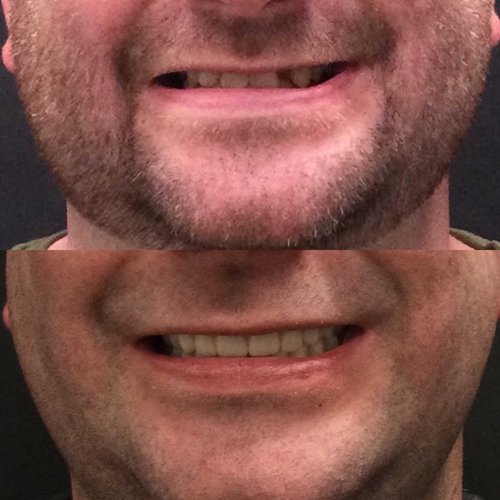 Before and after comparison of man's smile showing denture improvement results.