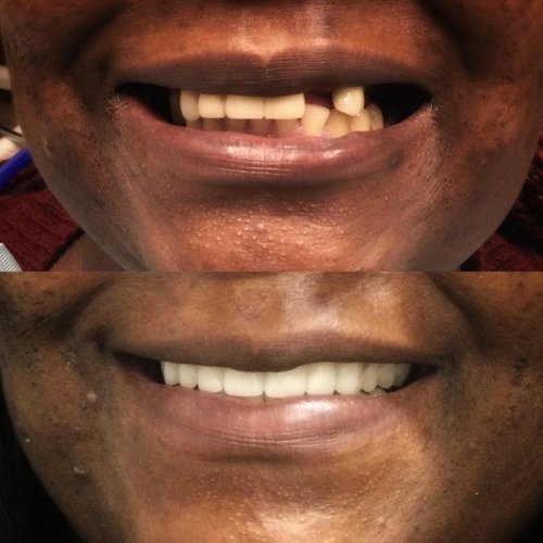 Before and after comparison of smile transformation with dental prosthetics showing improved tooth appearance and alignment.