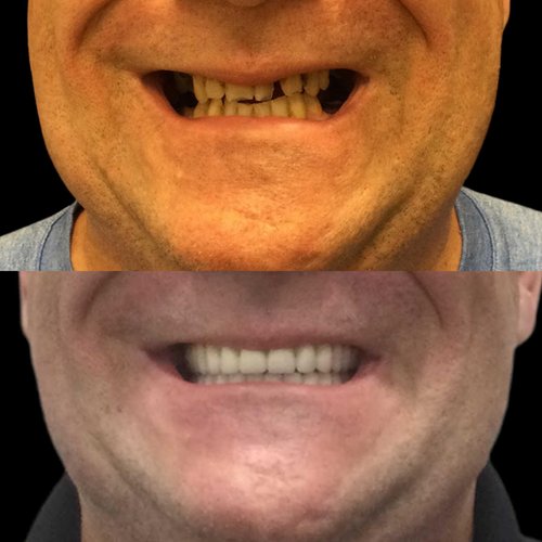 Before and after comparison of dental restoration showing missing teeth transformed to complete smile with dentures.