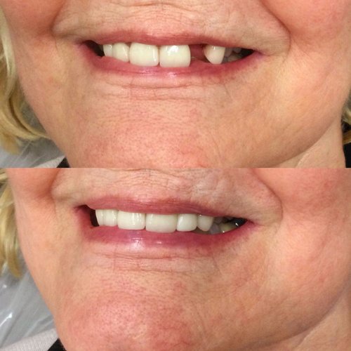 Before and after comparison of smile improvement with dental prosthetics treatment.