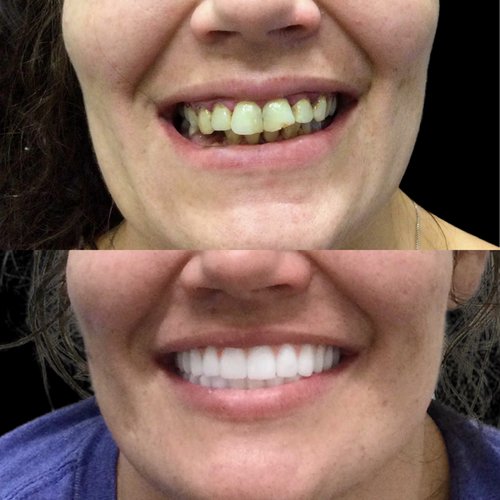 Before and after comparison of smile transformation with professional dentures treatment.