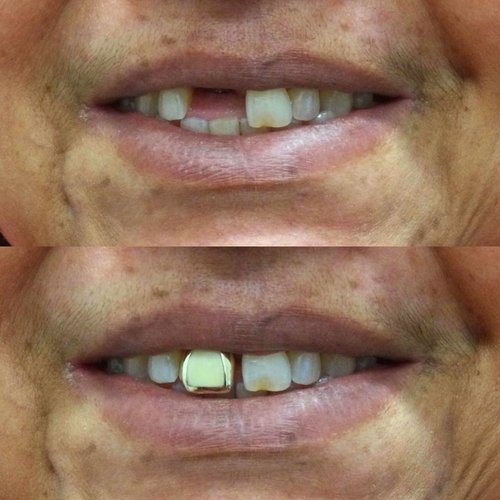 Before and after comparison of dental work showing improved tooth alignment and appearance.