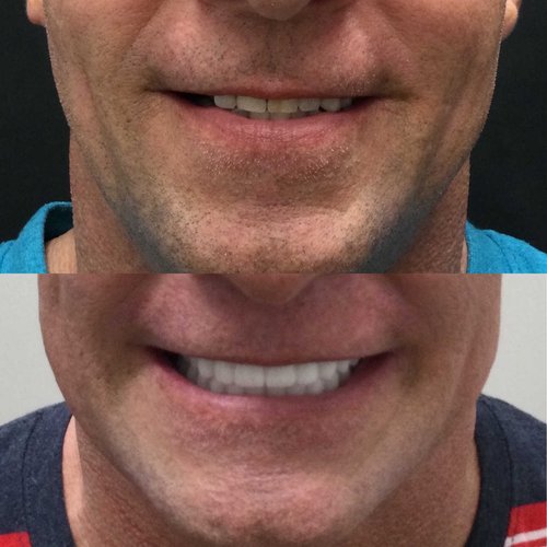 Before and after comparison of denture results showing improved smile and tooth appearance.