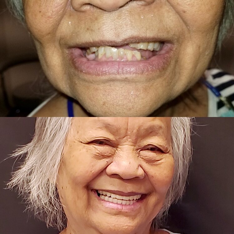 Two women smiling, displaying their teeth before and after denture treatment results.
