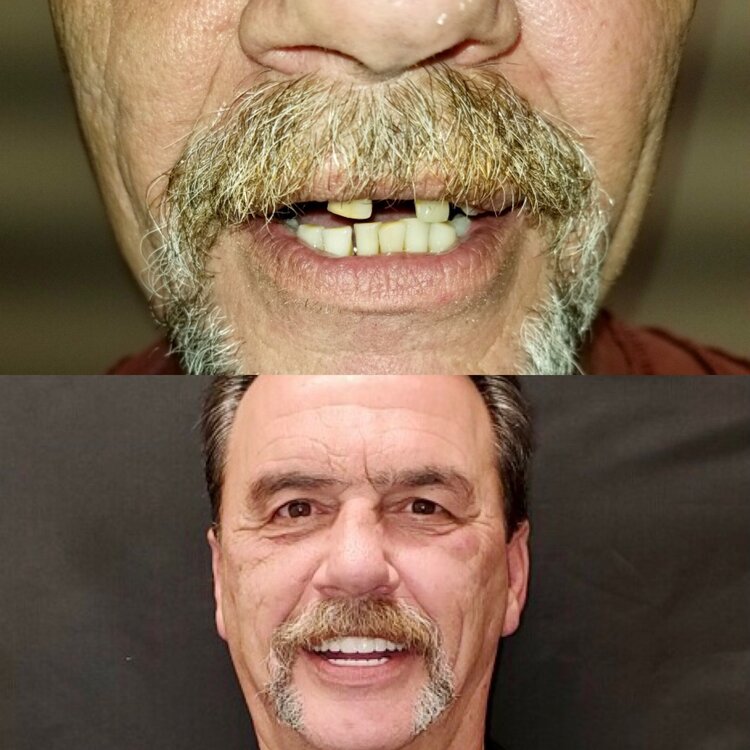 Before and after dentures comparison showing man's smile improvement with dental prosthetics.