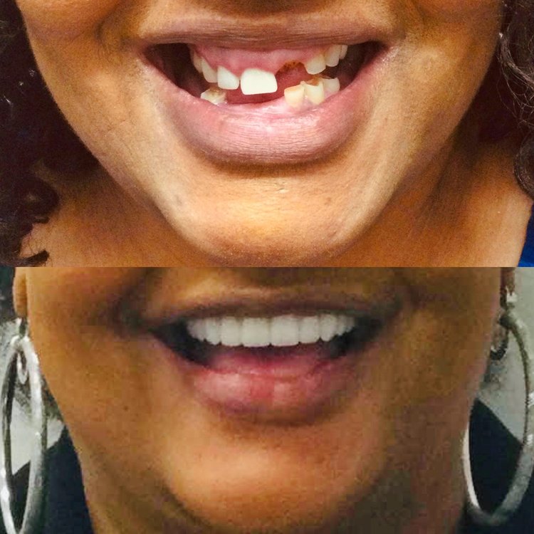 Before and after comparison of smile transformation showing dental improvement with dentures.