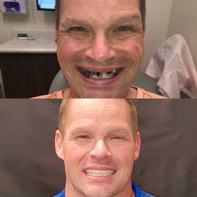 Before and after comparison showing man's smile transformation with professional dentures in dental office setting.
