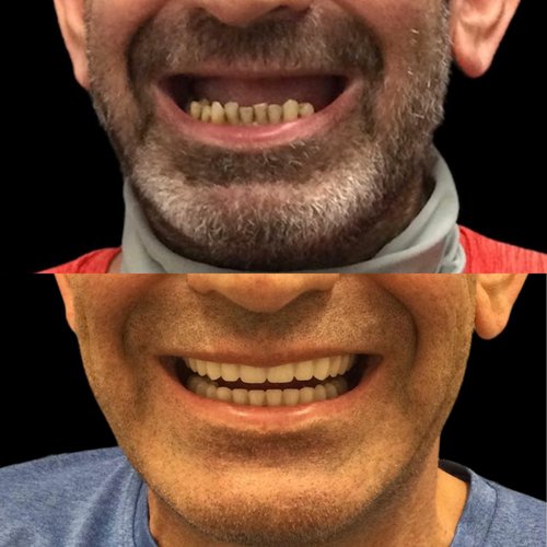 Before and after comparison of denture transformation showing improved smile and tooth appearance.