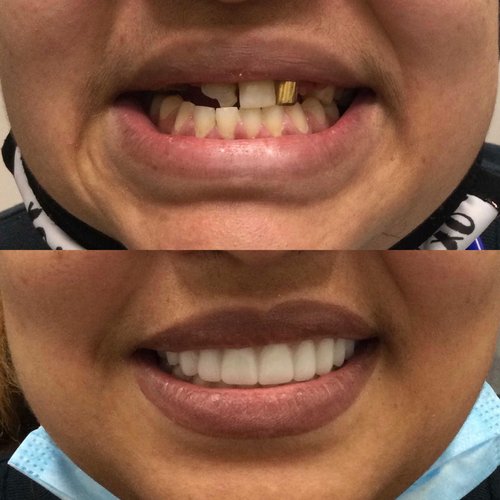 Before and after comparison of dental transformation showing improved tooth appearance and smile restoration.