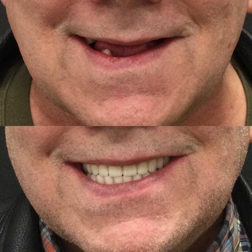 Before and after comparison of smile transformation with professional dentures, showing improved dental appearance.