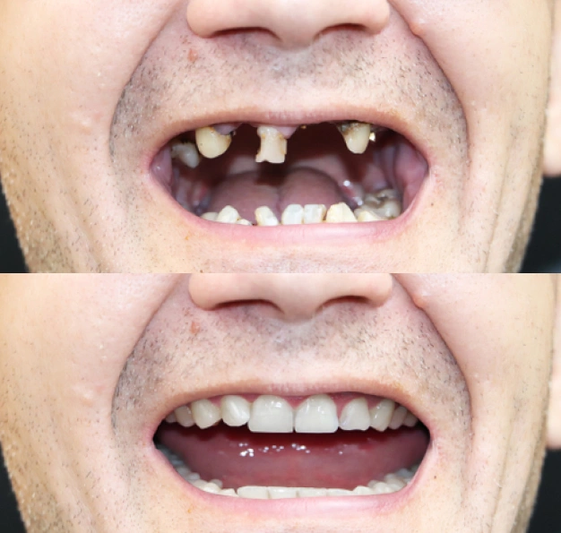 Before and after comparison showing dental transformation with missing teeth versus complete smile with dentures.