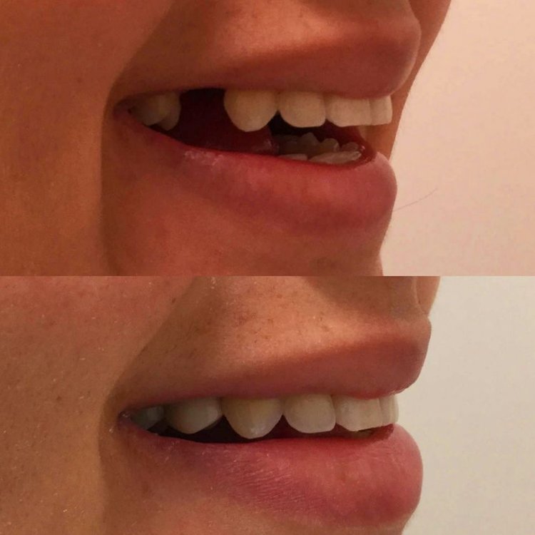 Before and after comparison of smile with dentures, showing improved tooth alignment and appearance.
