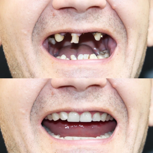 Before and after comparison of dental restoration showing damaged teeth transformed into a complete white smile.