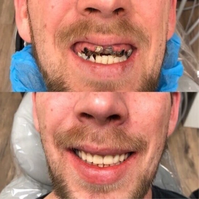 Before and after comparison showing dental transformation with improved smile and tooth alignment.