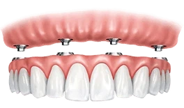 Dental prosthetic model showing pink gum tissue with white tooth-colored denture components attached.