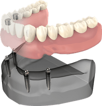 Dental implant dentures demonstration showing prosthetic teeth attachment on jaw model.