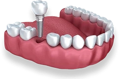 Dental implant model showing titanium screw and artificial tooth crown on gum replica.