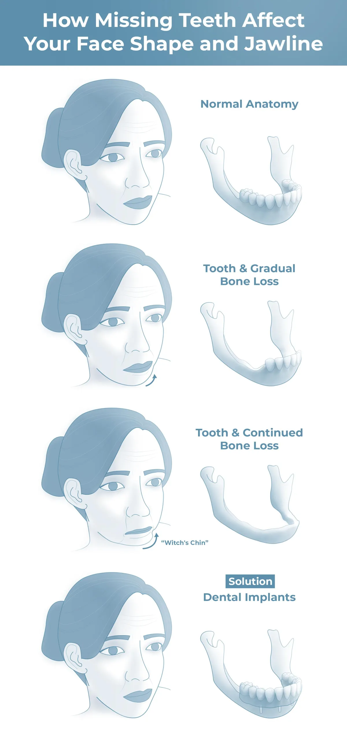 Infographic showing four female profile illustrations demonstrating how missing teeth affect jawline and facial shape.