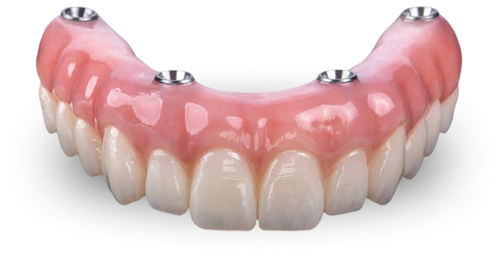 Implant-supported denture prosthetic showing pink gum base with artificial teeth attached to metal posts.