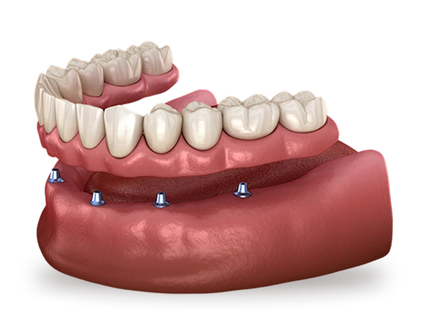 3D dental model showing implant-supported dentures with attachment points on jawbone structure.