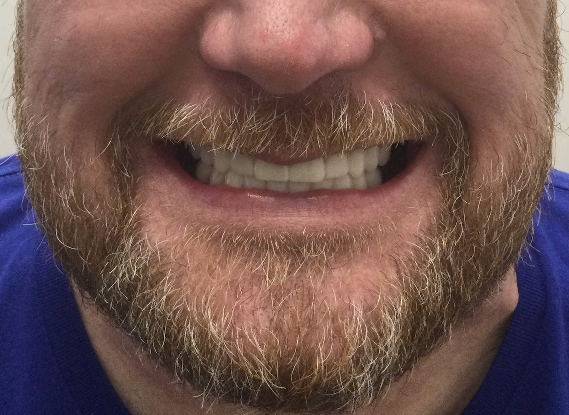 Man smiling displaying dental work, close-up of face and teeth against neutral background.