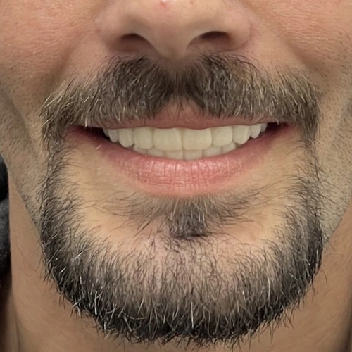 Man with full beard smiling, displaying natural-looking dentures in dental care setting.
