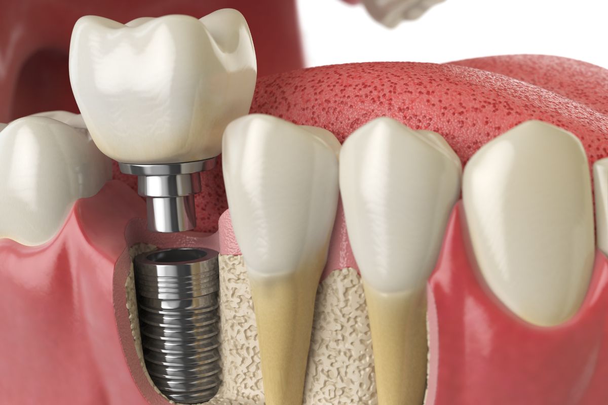 Is Age a Factor for Getting a Single Tooth Implant?