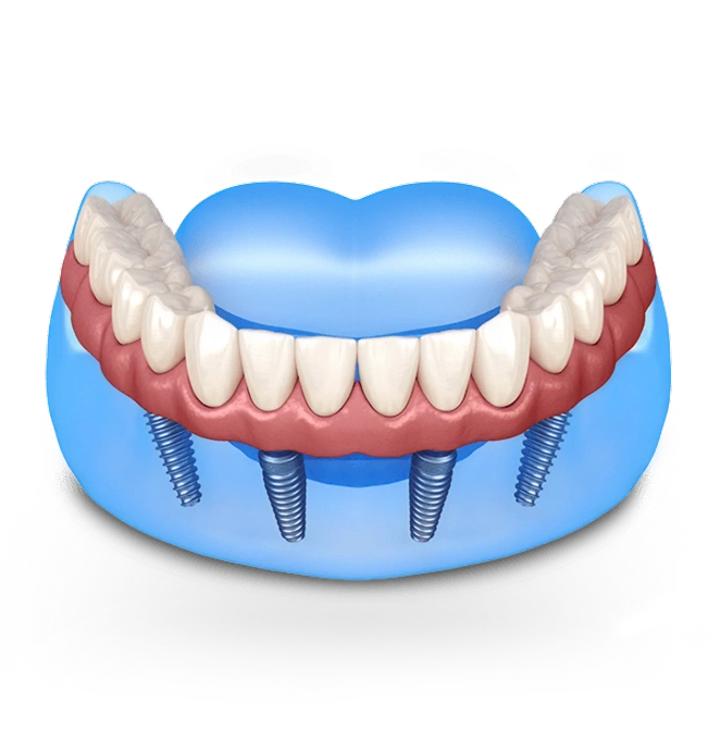 Dental implant model showing prosthetic teeth attached to blue base with four implant posts.