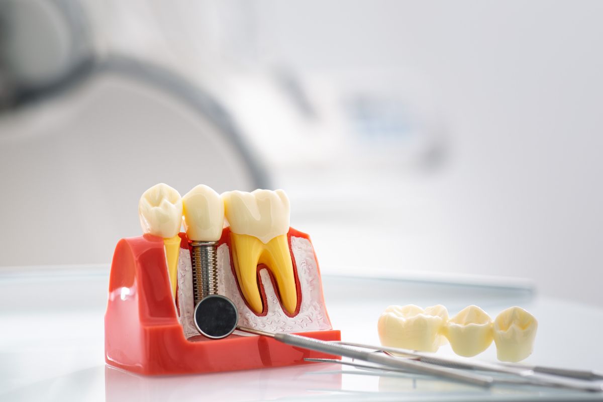 How Dentists Ensure Natural Looks With Single Tooth Implants?