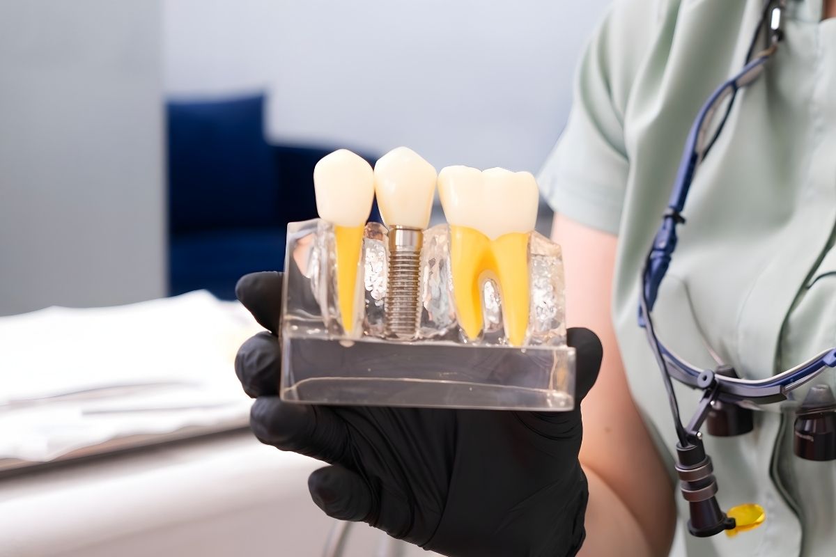 How Long to Complete Full Mouth Dental Implants