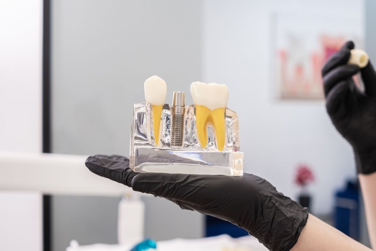 How Long Does a Dentist Take to Complete the Dental Implant Process?