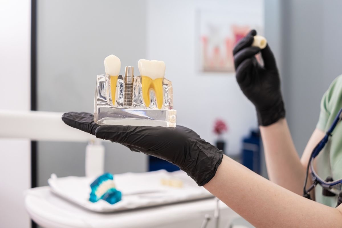 What Is the Recovery Time After Full Mouth Dental Implants?