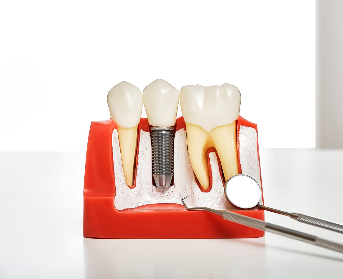 Snap In Implant Dentures in Ellendale